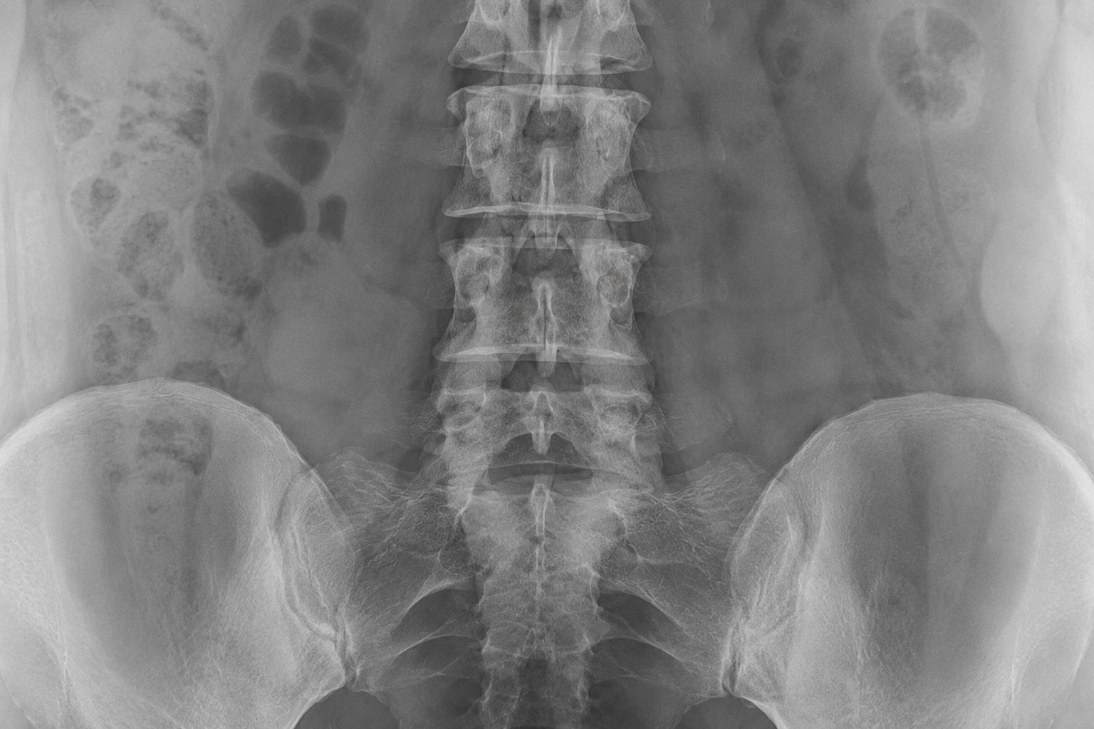 Epidural Blood Patch