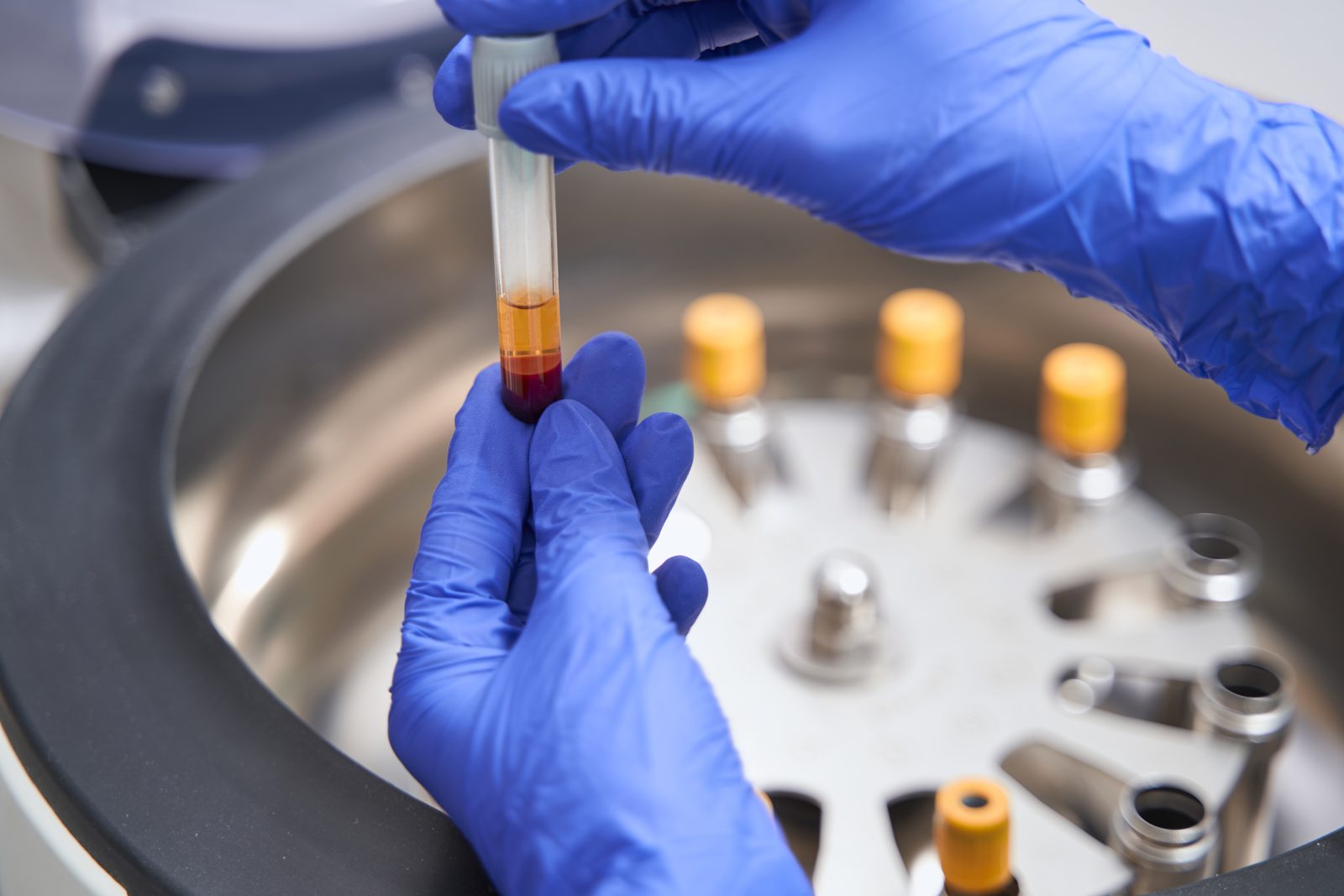 PRP Therapy